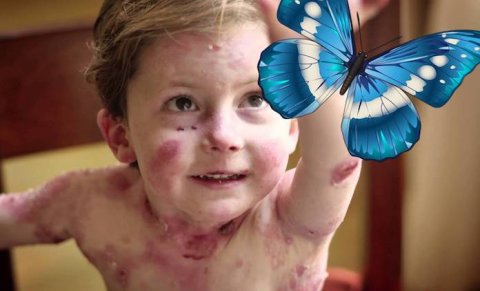 Kəpənək xəstəliyi ilə mübarizəyə 1,3 milyon vəsait ayrıldı